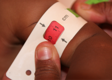 Madagascar-malnutrition-infantile-severe